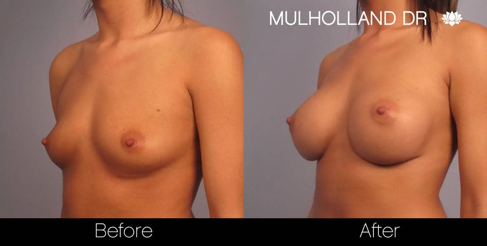 Mommy Makeover -Before and After Gallery - Patient Photo 17