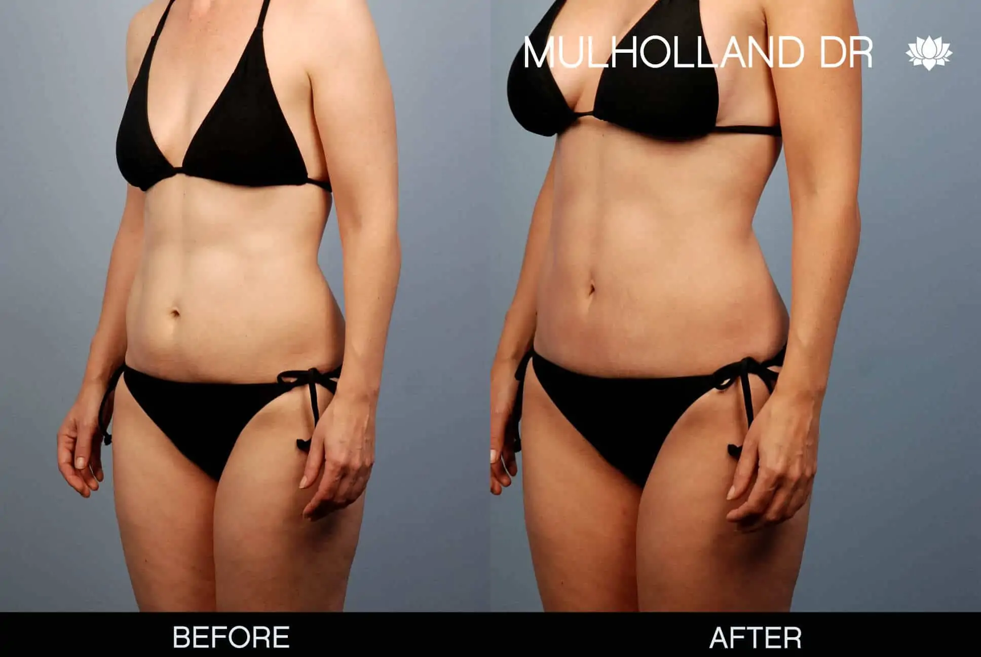 Mommy Makeover -Before and After Gallery - Patient Photo 2