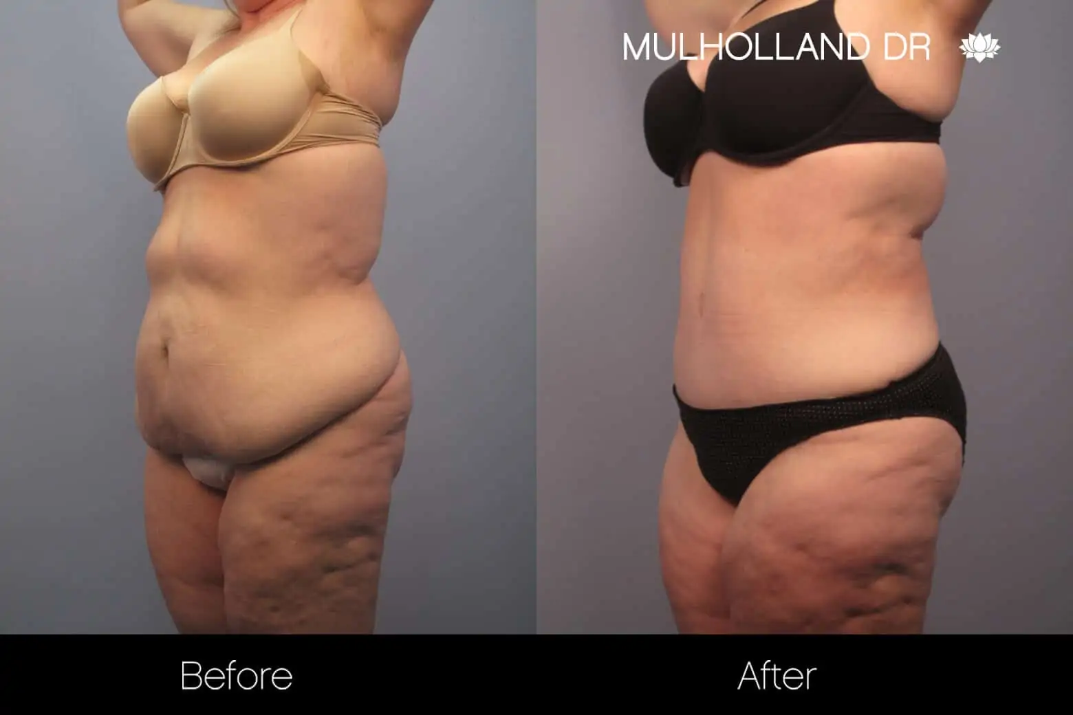 Mommy Makeover -Before and After Gallery - Patient Photo 24