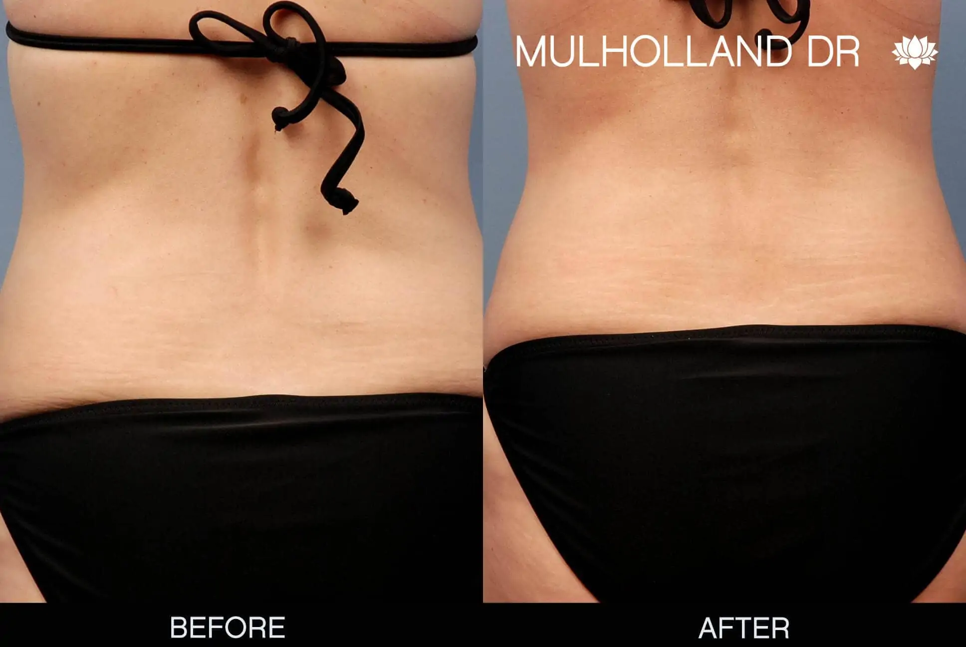 Mommy Makeover -Before and After Gallery - Patient Photo 5