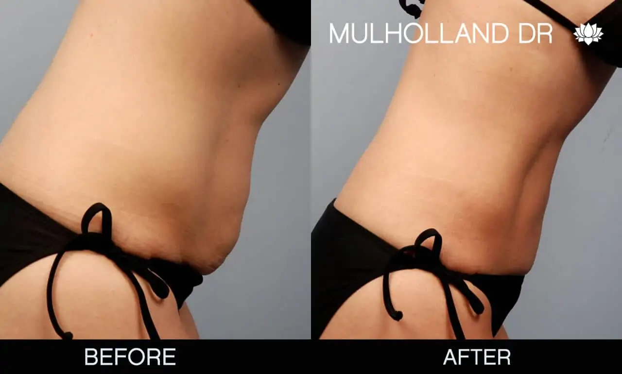 Mommy Makeover -Before and After Gallery - Patient Photo 6