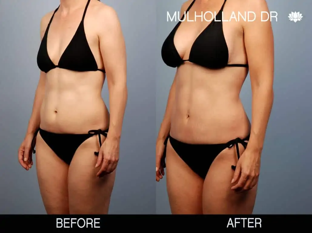 Mommy Makeover -Before and After Gallery - Patient Photo 9