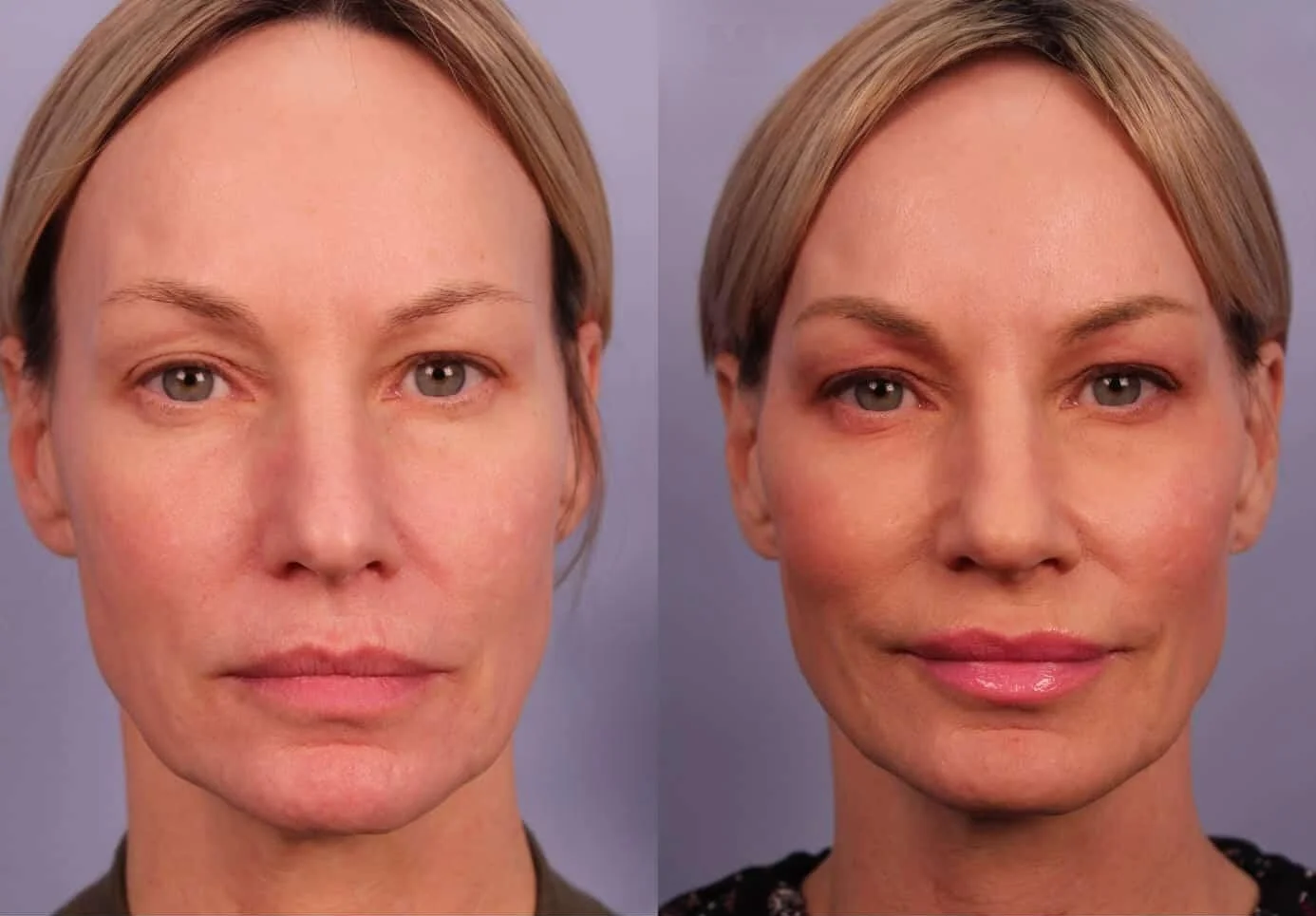 Morpheus8- Before and After Gallery - Patient Photo 1