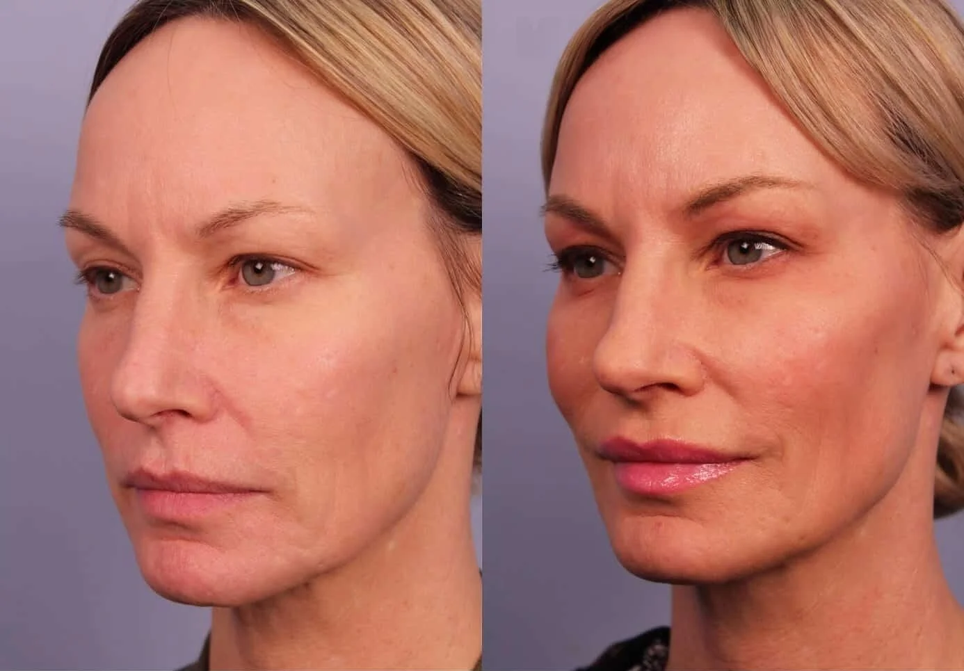 Morpheus8- Before and After Gallery - Patient Photo 2