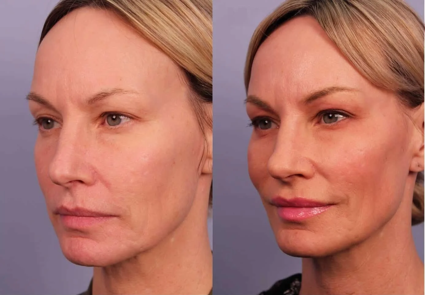 Morpheus8- Before and After Gallery - Patient Photo 3