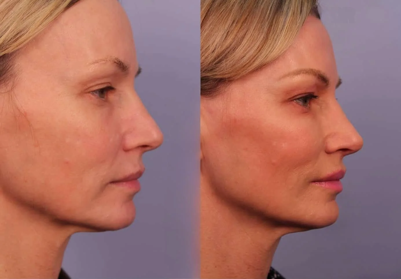 Morpheus8- Before and After Gallery - Patient Photo 4