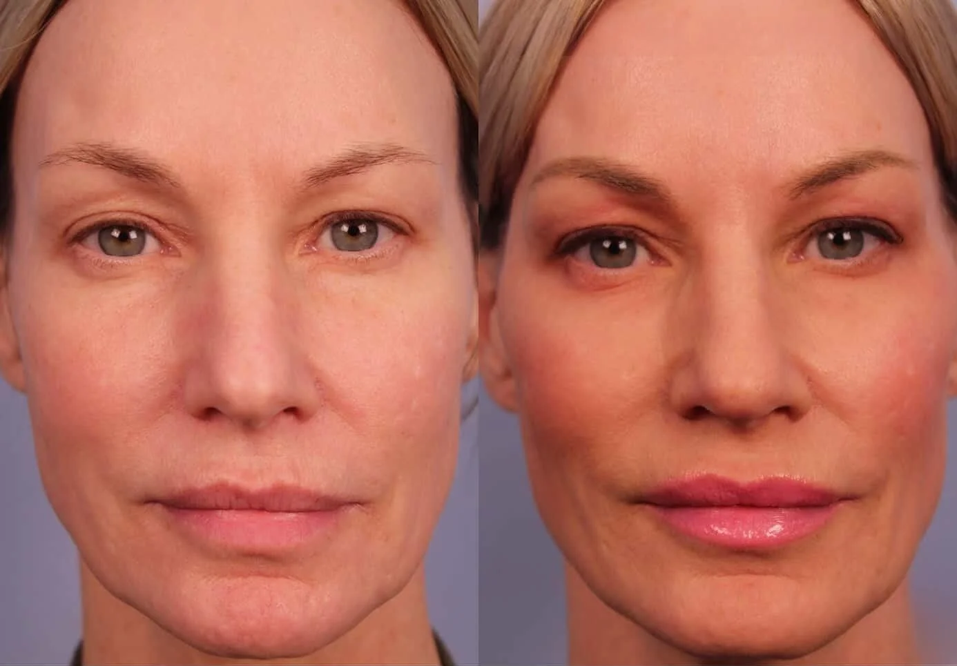 Morpheus8- Before and After Gallery - Patient Photo 5