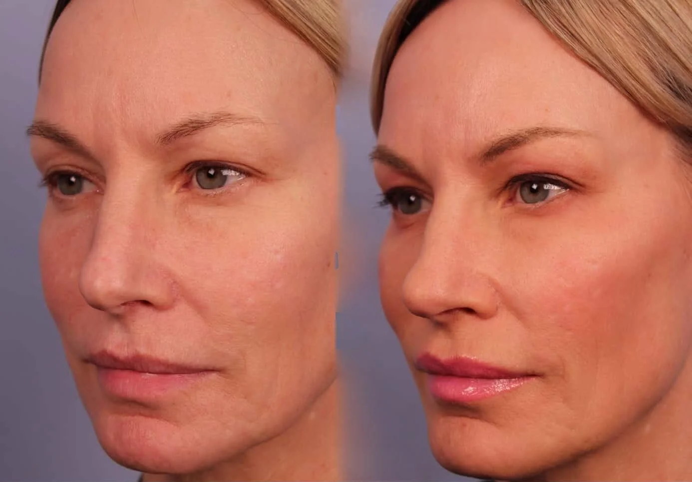 Morpheus8- Before and After Gallery - Patient Photo 6