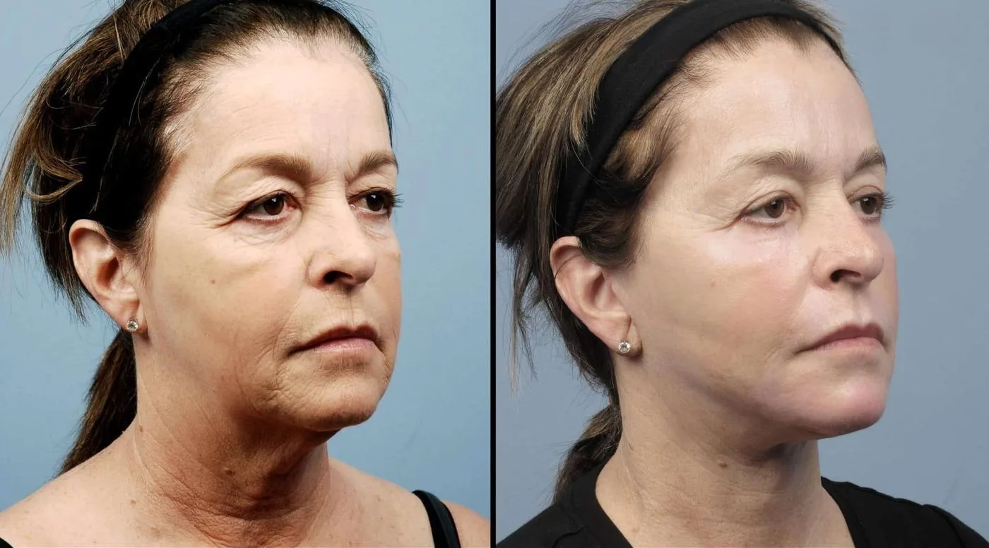Neck Lift - Before and After Gallery - Patient Photo 10