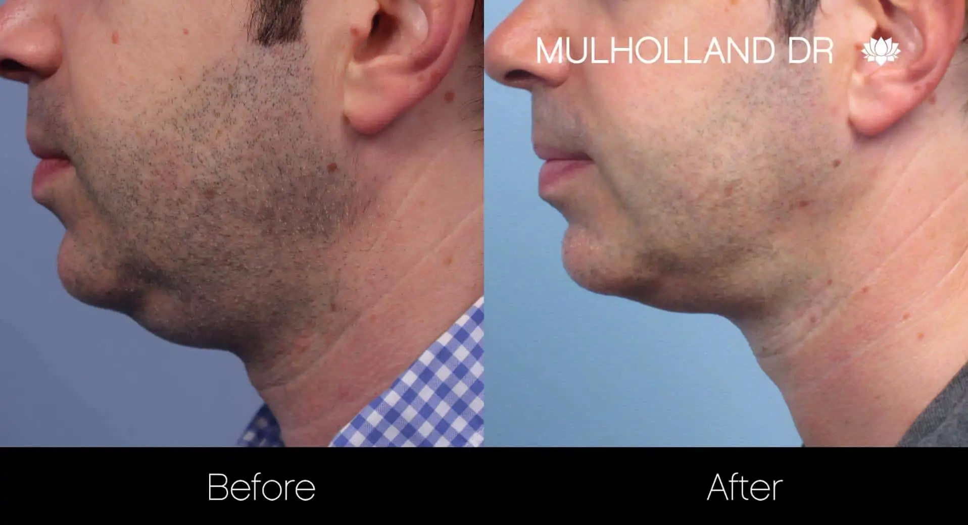 Neck Lift - Before and After Gallery - Patient Photo 101