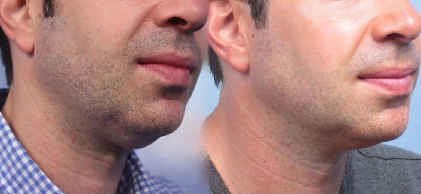 Neck Lift - Before and After Gallery - Patient Photo 102