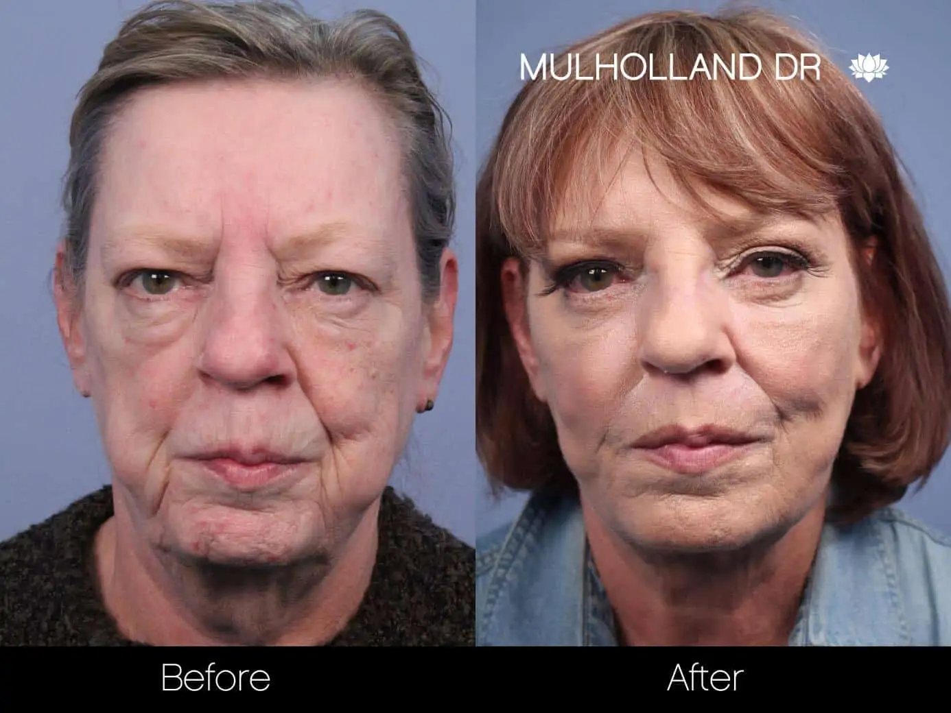 Neck Lift - Before and After Gallery - Patient Photo 106