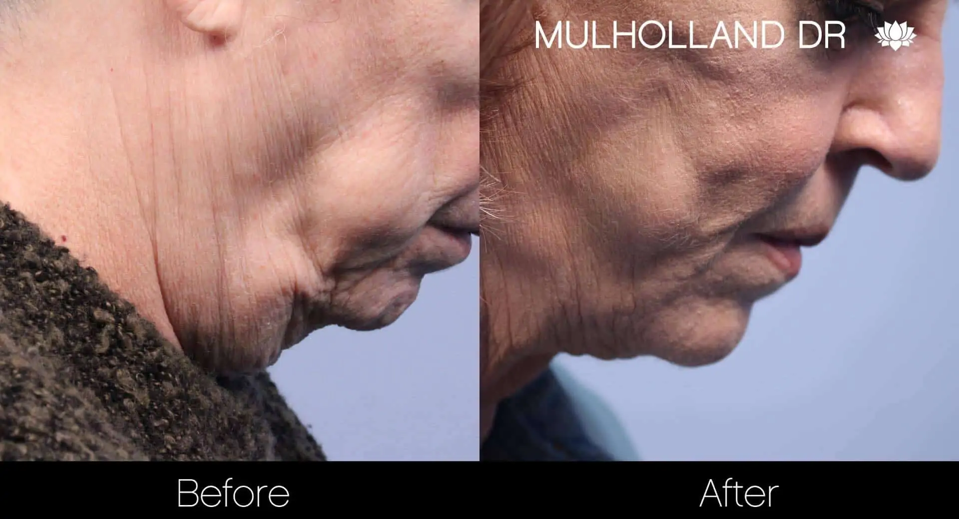 Neck Lift - Before and After Gallery - Patient Photo 108