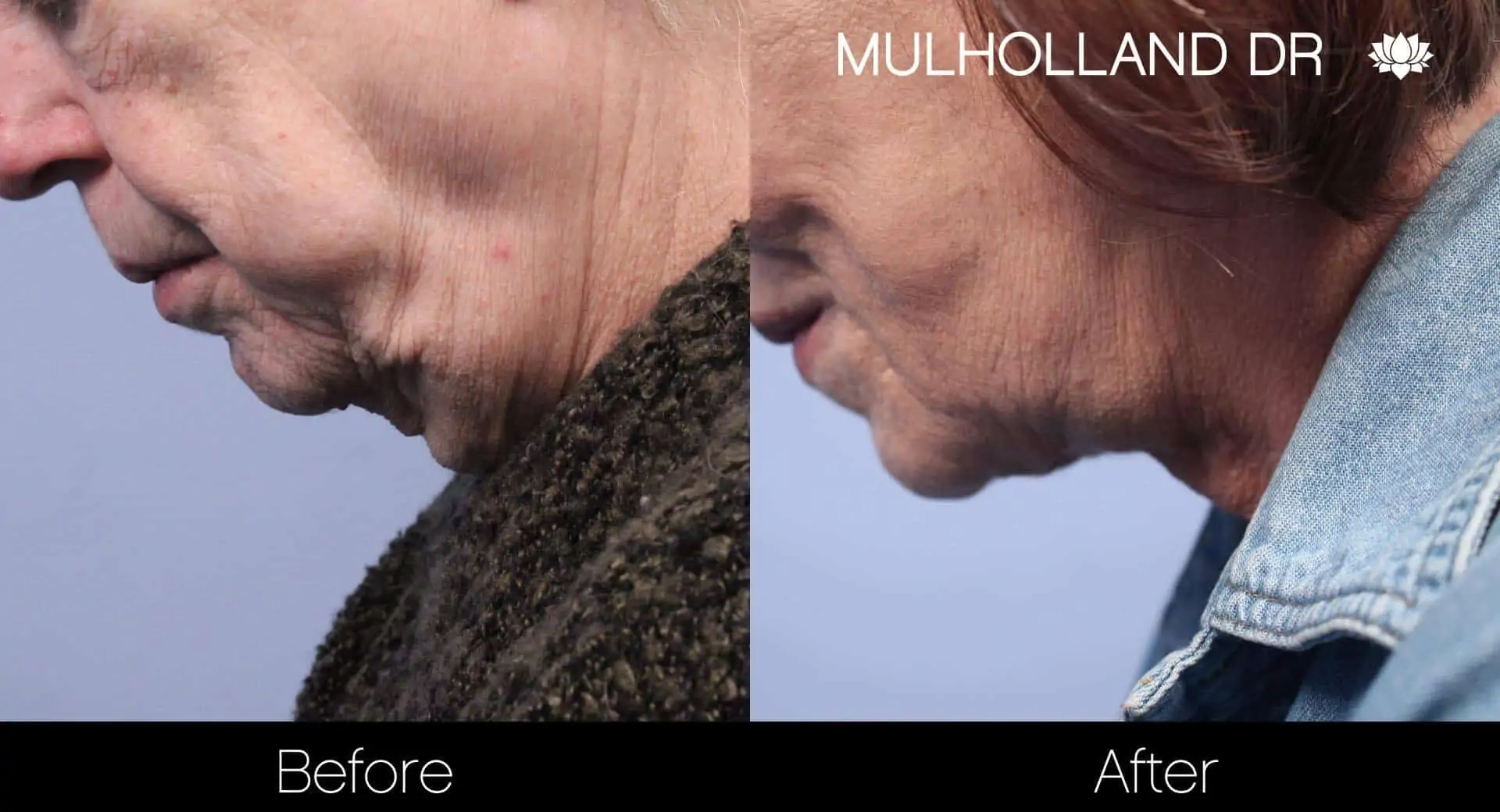 Neck Lift - Before and After Gallery - Patient Photo 109