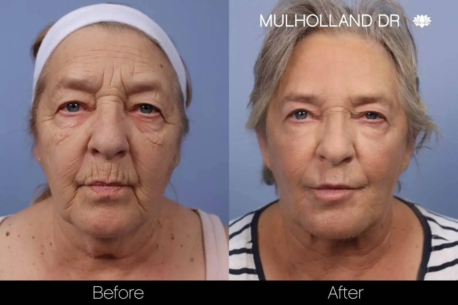Neck Lift - Before and After Gallery - Patient Photo 115