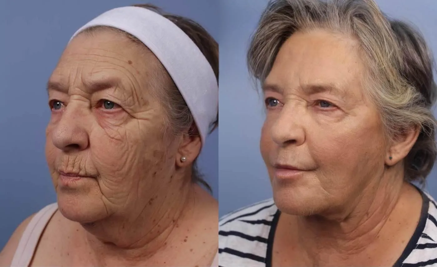 Neck Lift - Before and After Gallery - Patient Photo 116