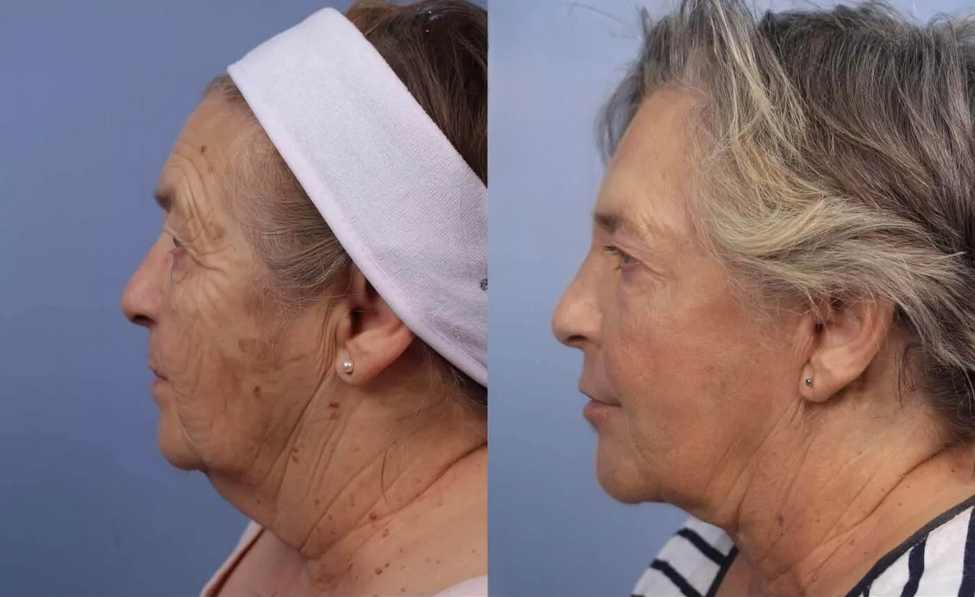Neck Lift - Before and After Gallery - Patient Photo 117