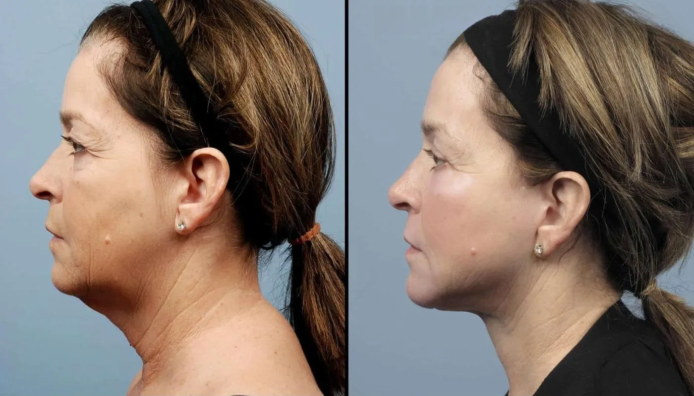 Neck Lift - Before and After Gallery - Patient Photo 12