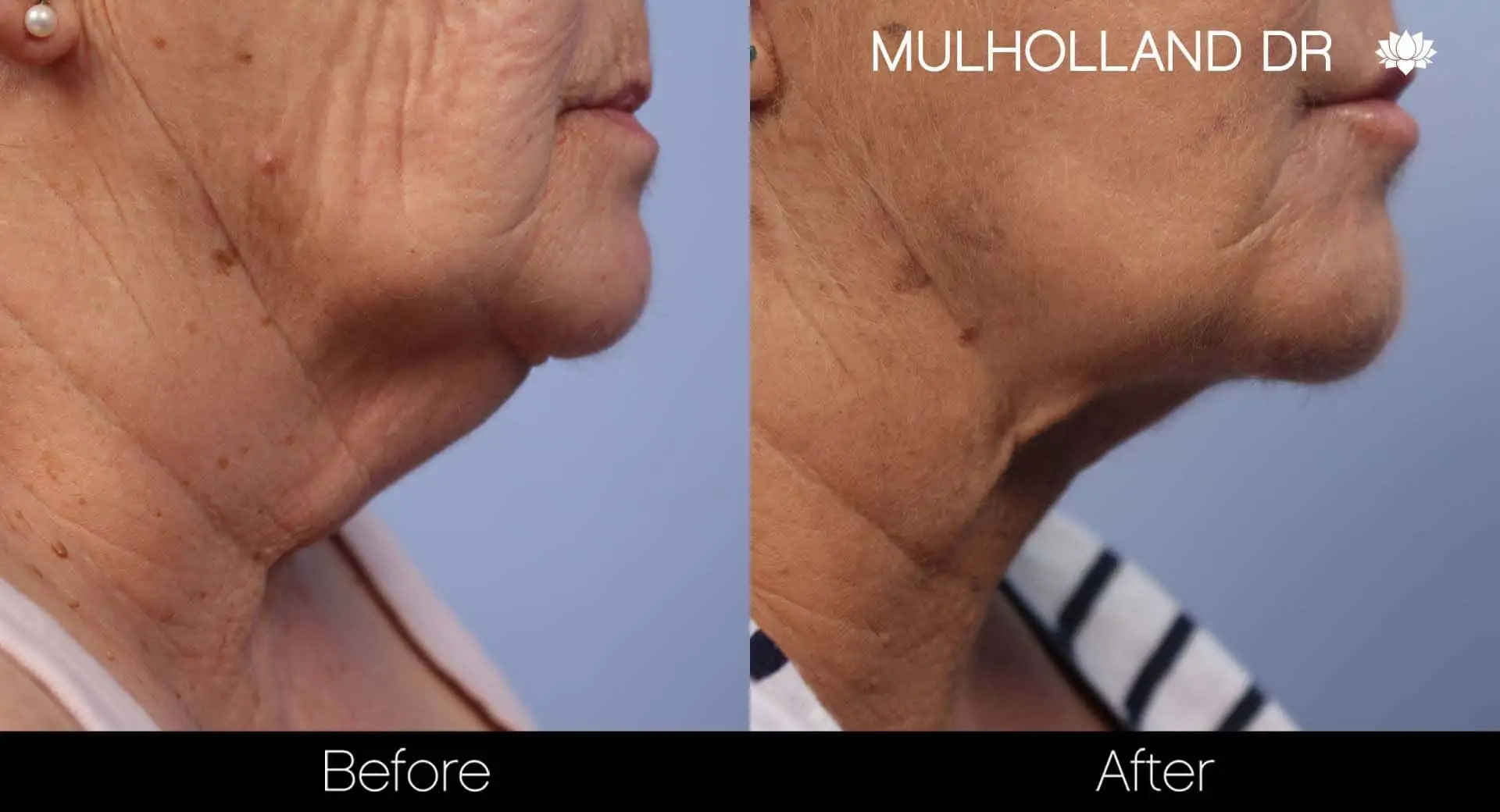 Neck Lift - Before and After Gallery - Patient Photo 125