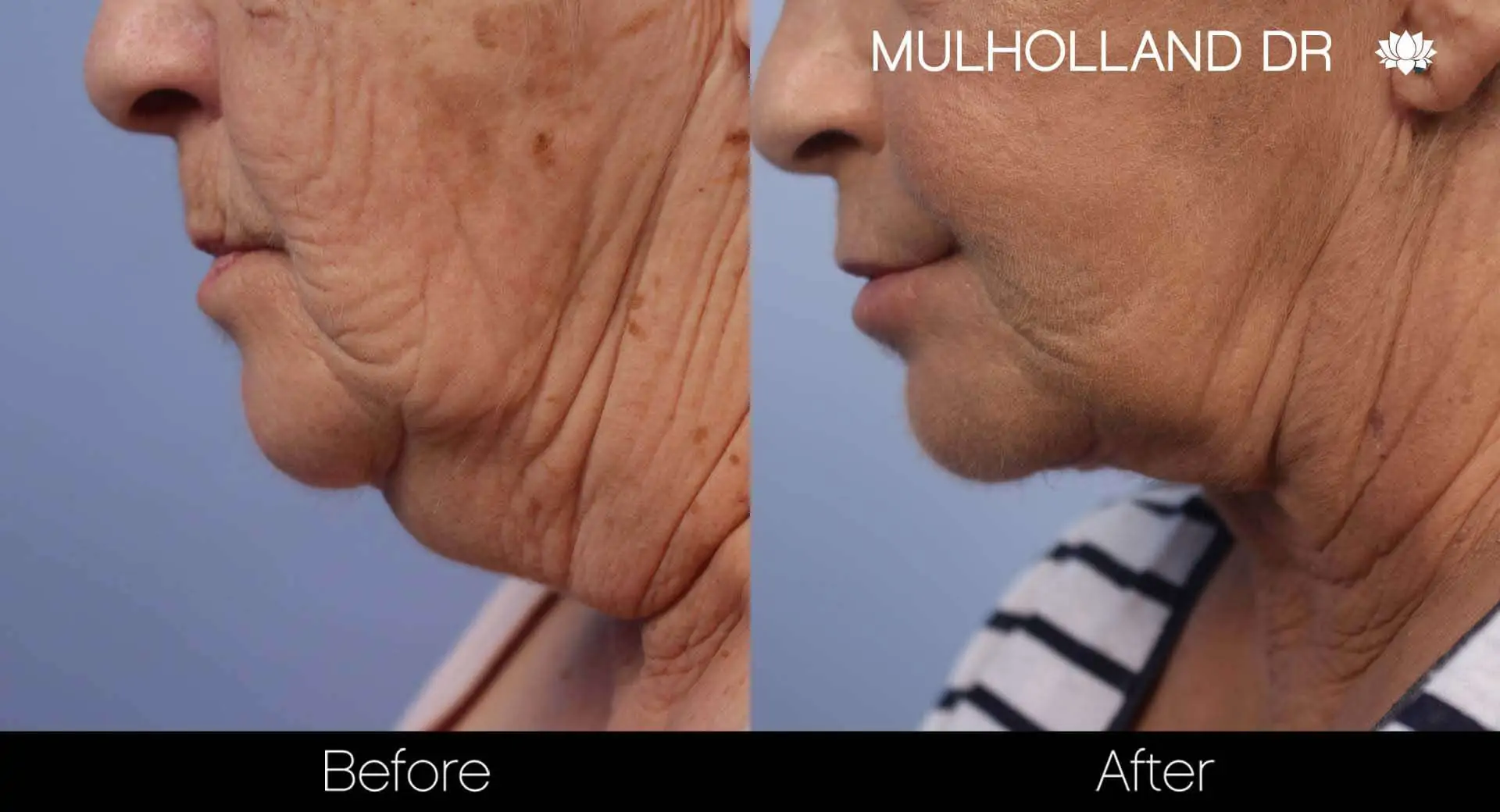 Neck Lift - Before and After Gallery - Patient Photo 126