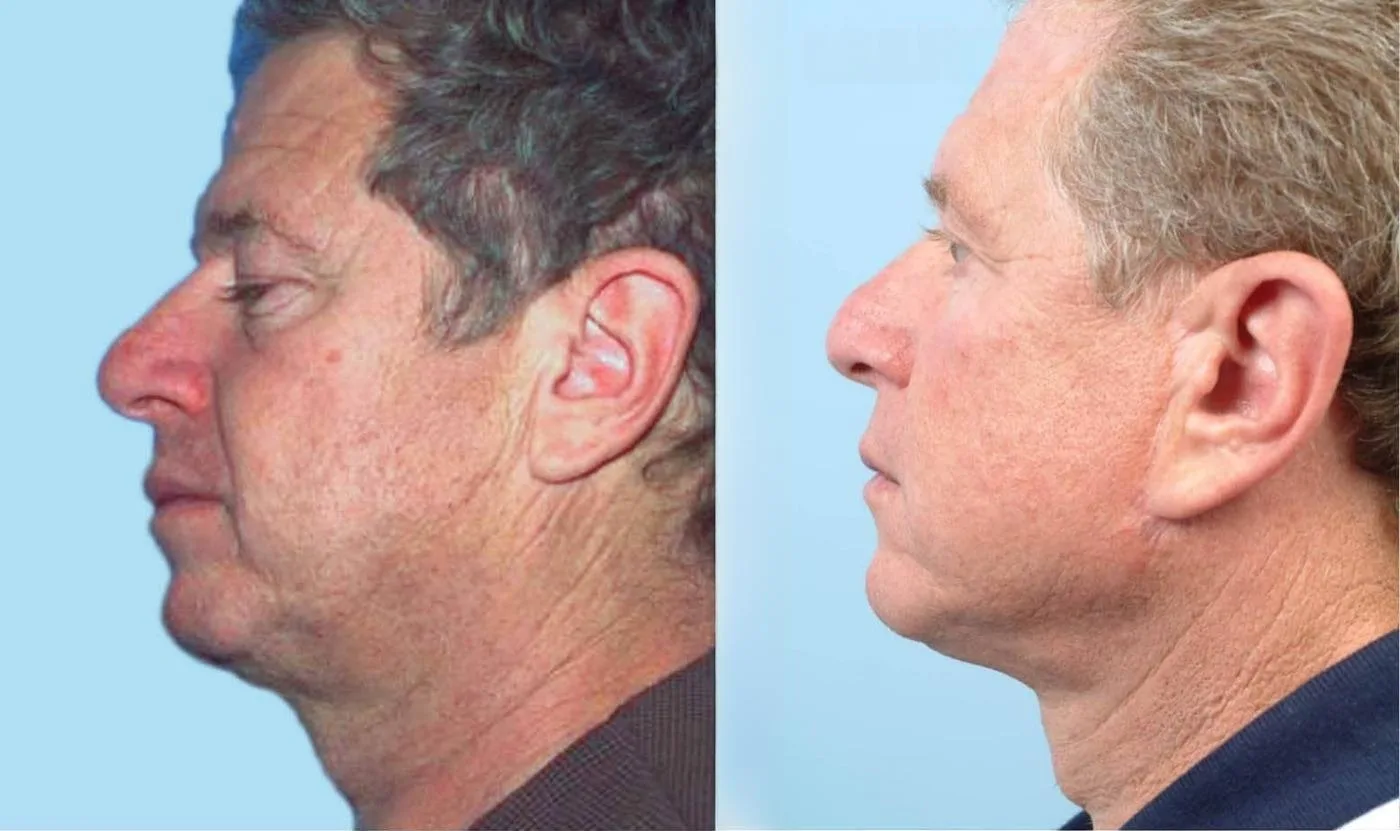 Neck Lift - Before and After Gallery - Patient Photo 129