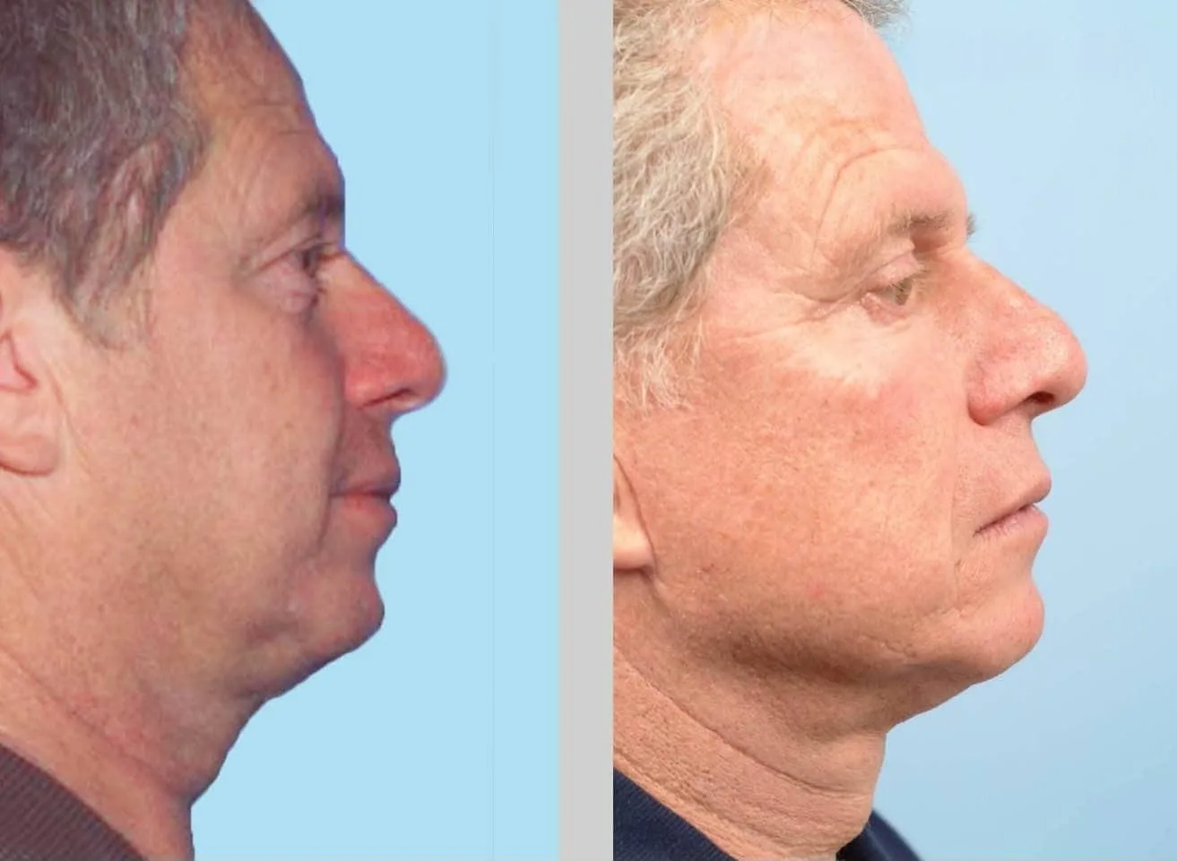 Neck Lift - Before and After Gallery - Patient Photo 130