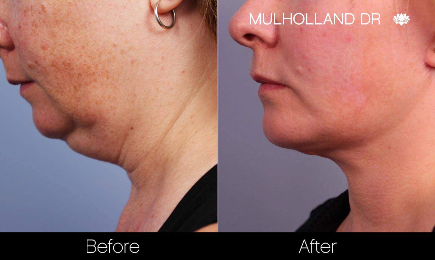 Neck Lift - Before and After Gallery - Patient Photo 133