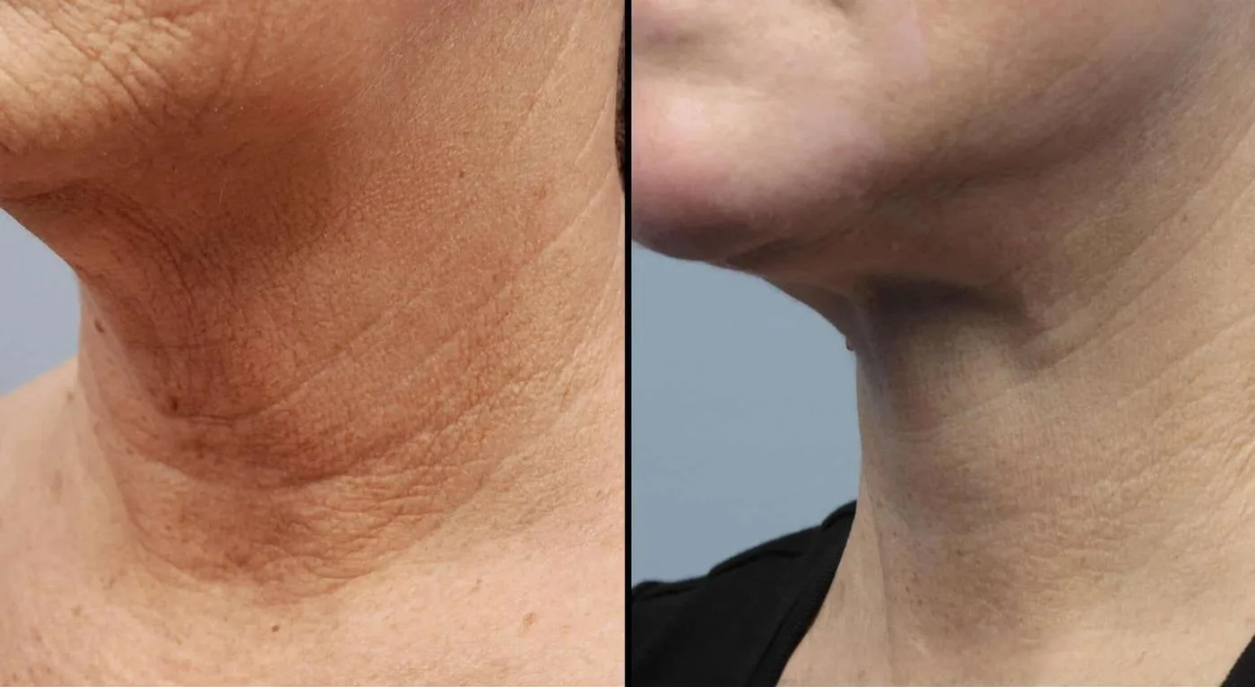 Neck Lift - Before and After Gallery - Patient Photo 14