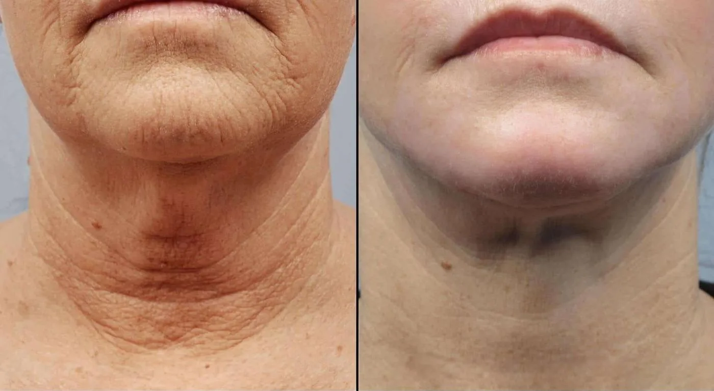 Neck Lift - Before and After Gallery - Patient Photo 16