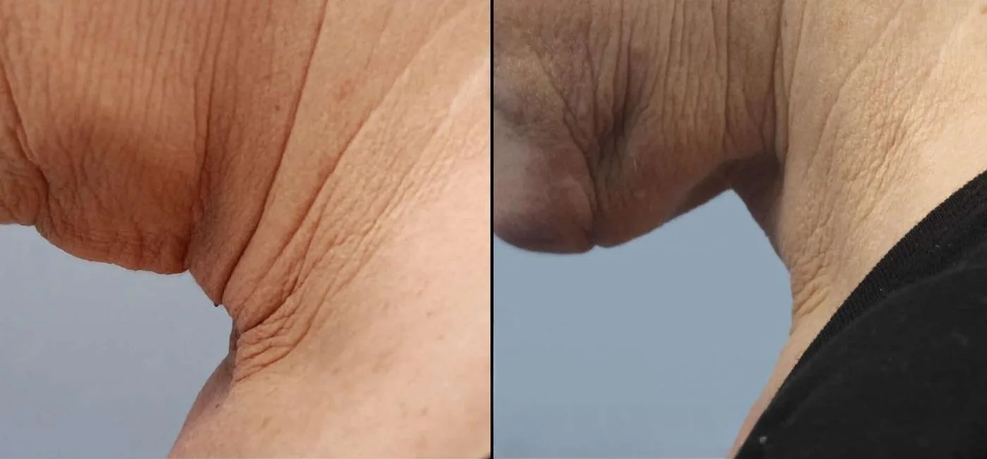 Neck Lift - Before and After Gallery - Patient Photo 18