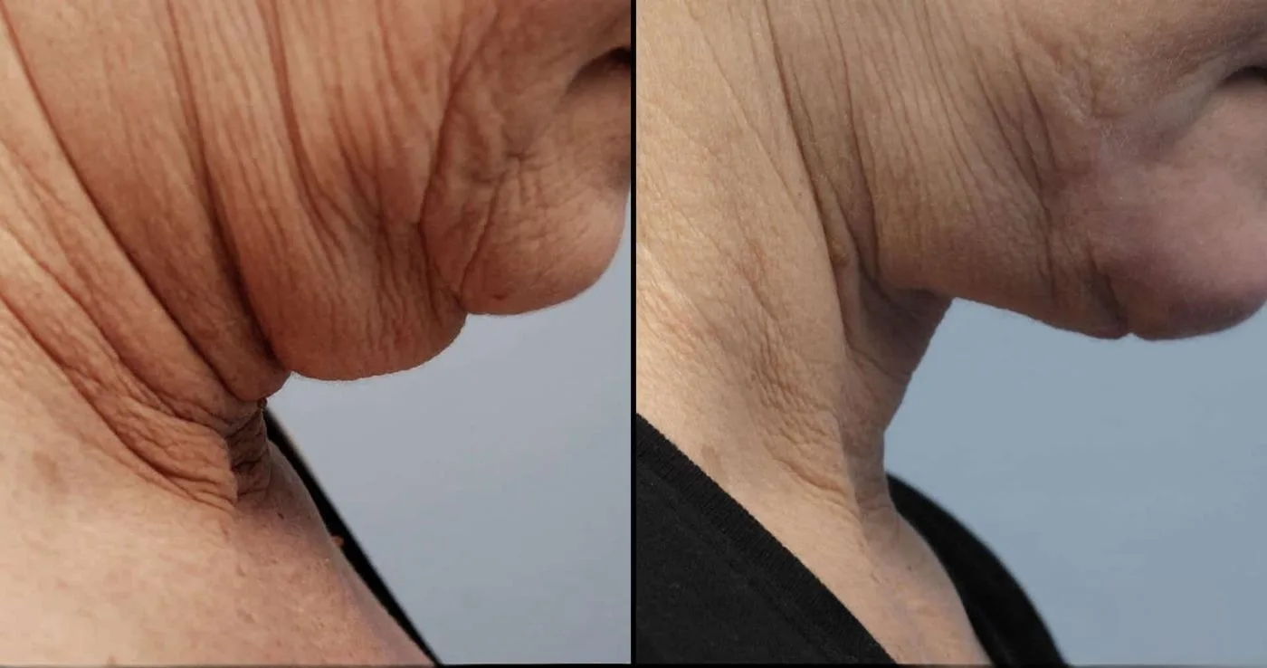 Neck Lift - Before and After Gallery - Patient Photo 19