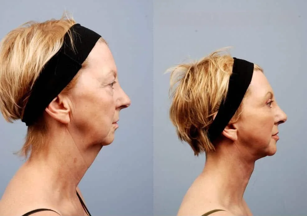 Neck Lift - Before and After Gallery - Patient Photo 2
