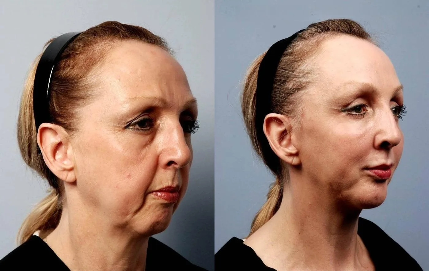 Neck Lift - Before and After Gallery - Patient Photo 21