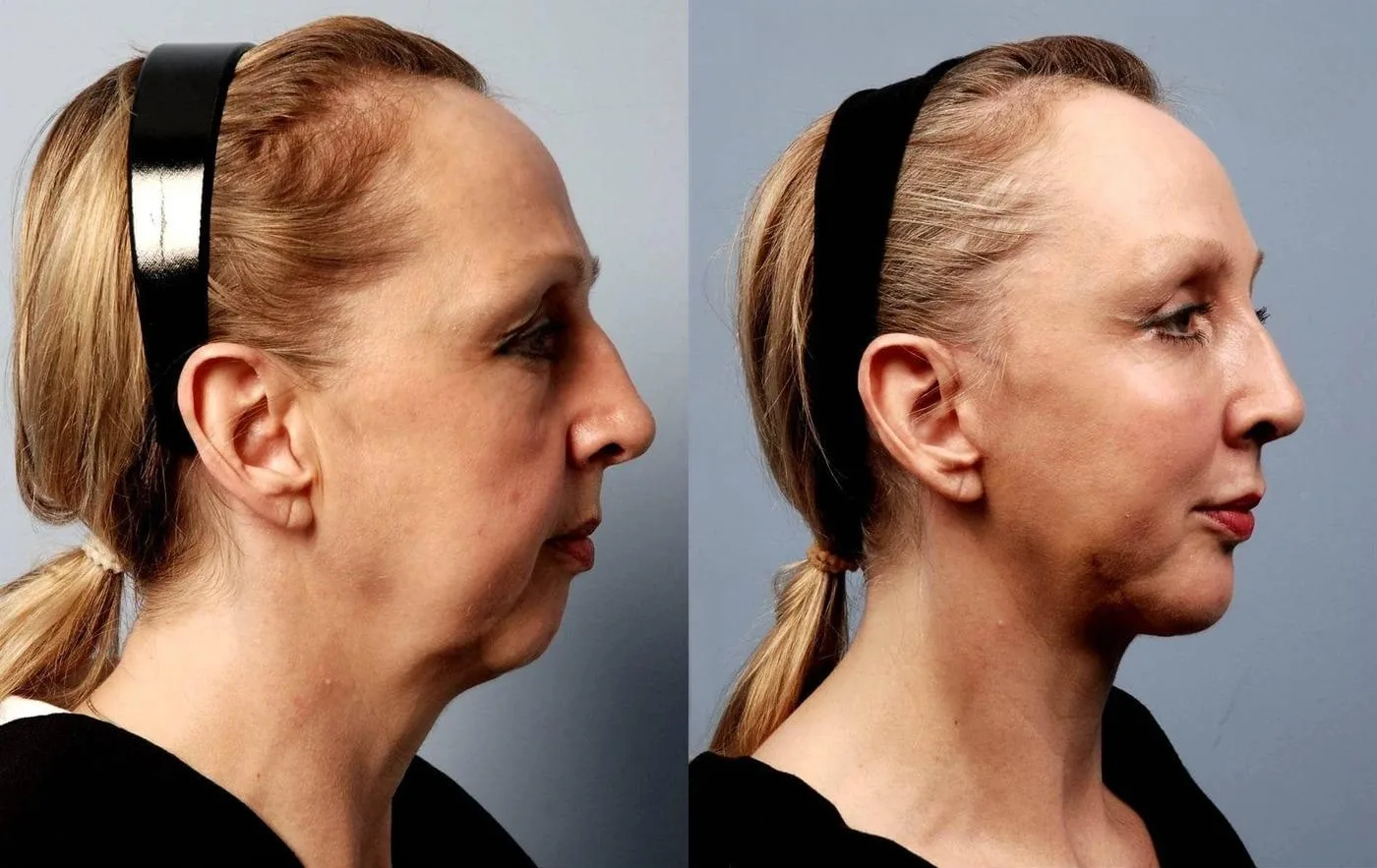 Neck Lift - Before and After Gallery - Patient Photo 24