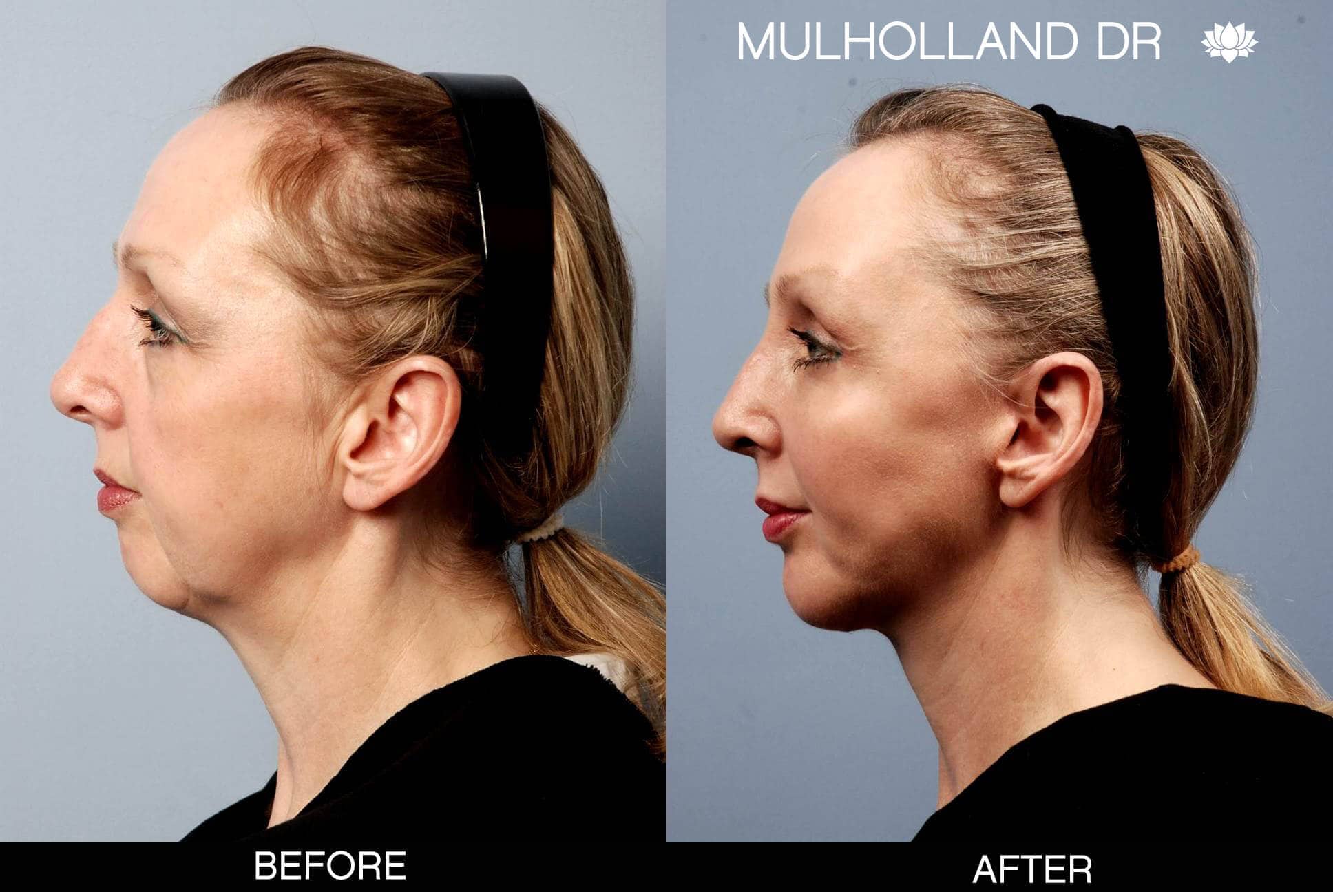Neck Lift - Before and After Gallery - Patient Photo 26