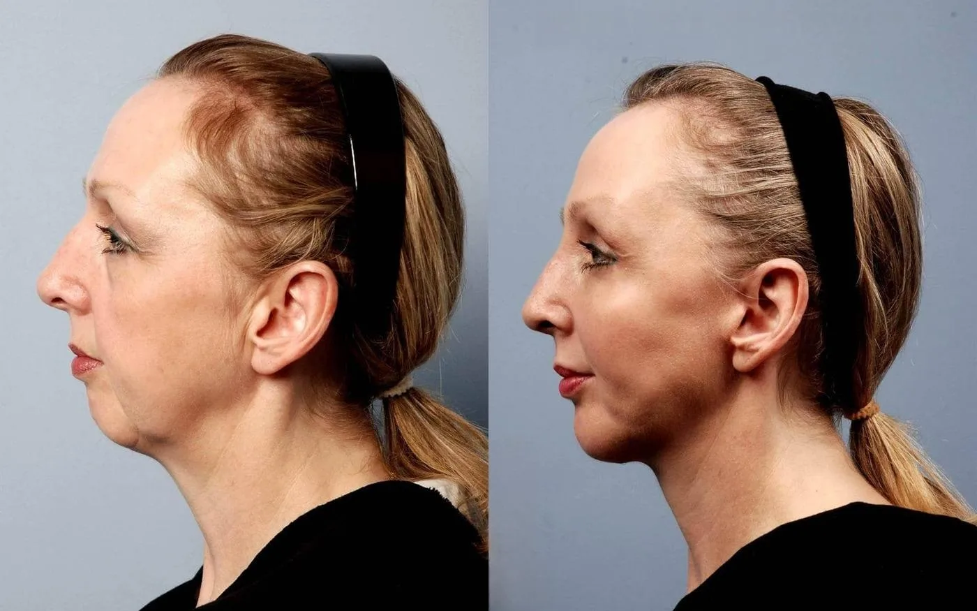 Neck Lift - Before and After Gallery - Patient Photo 26