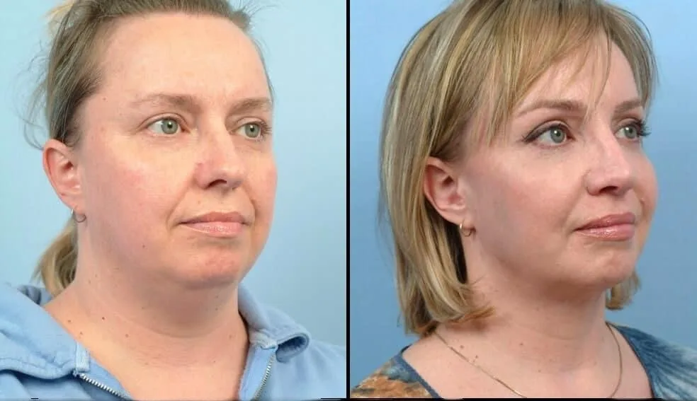 Neck Lift - Before and After Gallery - Patient Photo 28
