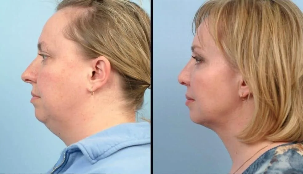 Neck Lift - Before and After Gallery - Patient Photo 29