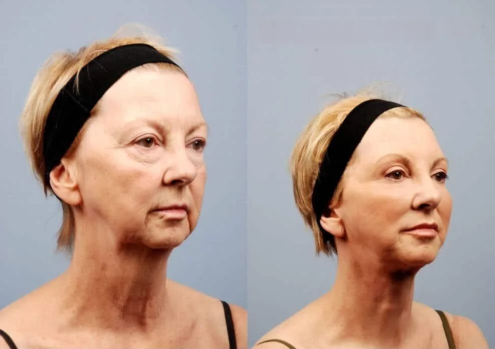 Neck Lift - Before and After Gallery - Patient Photo 3