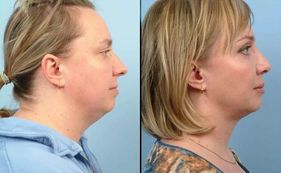 Neck Lift - Before and After Gallery - Patient Photo 30