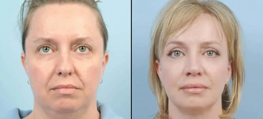 Neck Lift - Before and After Gallery - Patient Photo 31