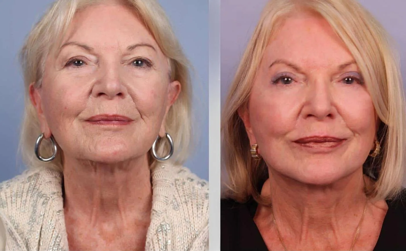 Neck Lift - Before and After Gallery - Patient Photo 32