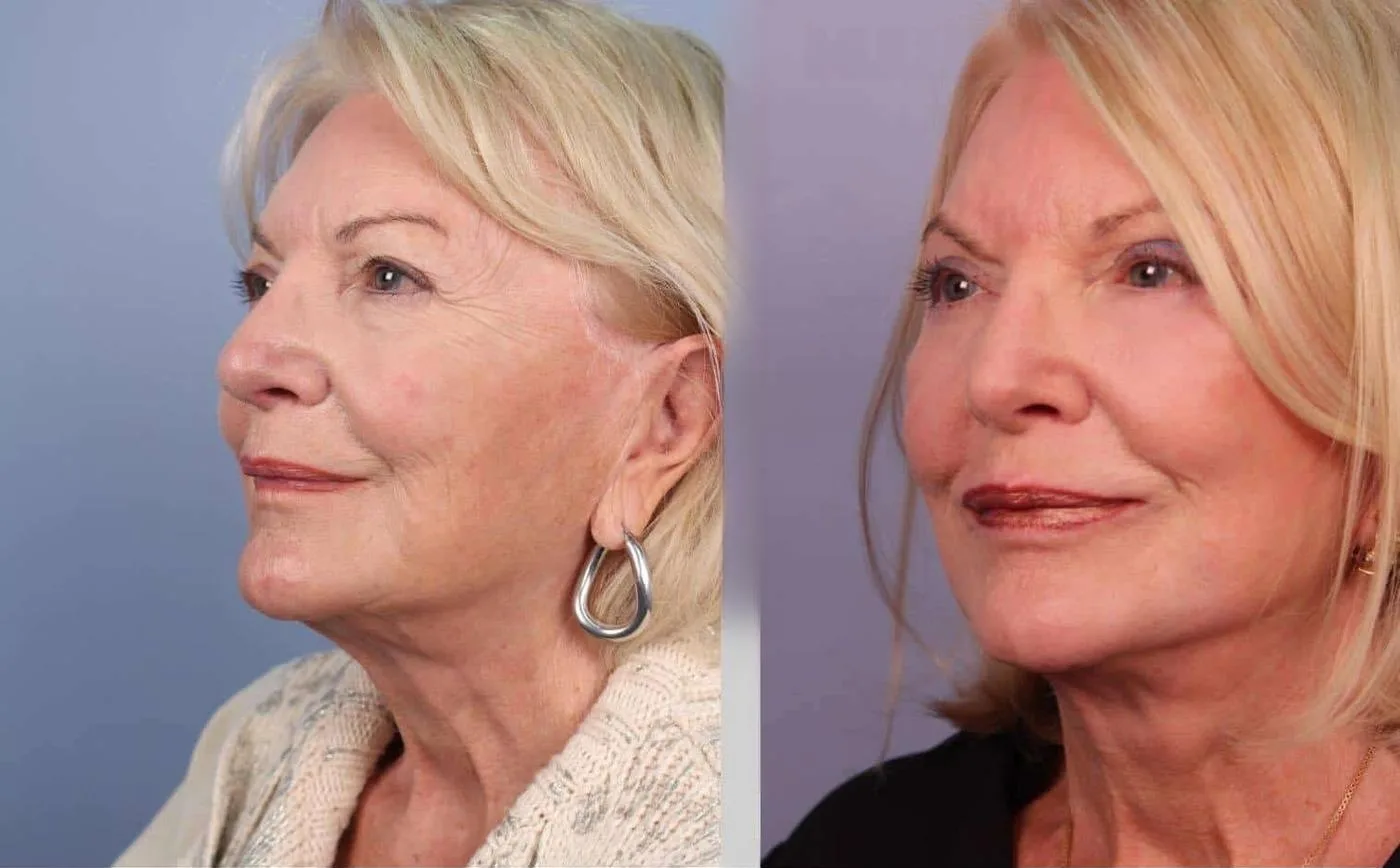 Neck Lift - Before and After Gallery - Patient Photo 33