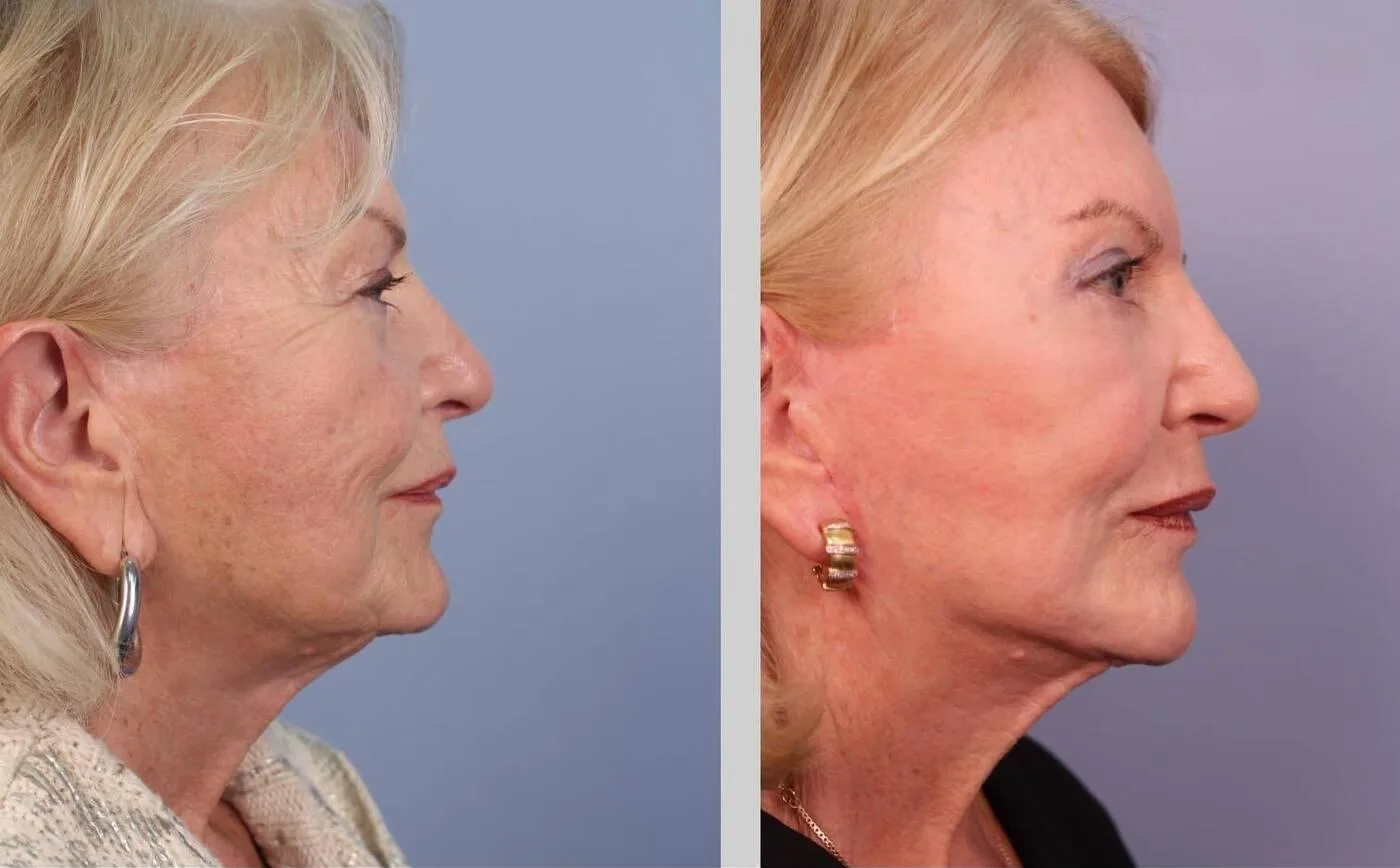Neck Lift - Before and After Gallery - Patient Photo 34