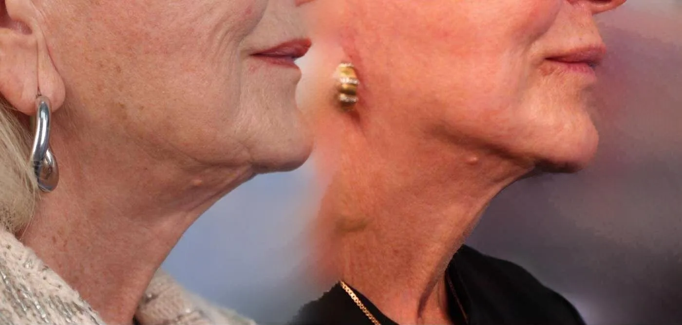 Neck Lift - Before and After Gallery - Patient Photo 35