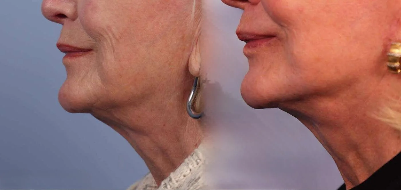 Neck Lift - Before and After Gallery - Patient Photo 36