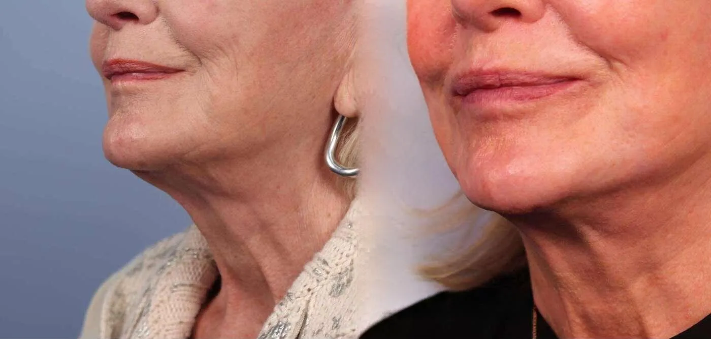 Neck Lift - Before and After Gallery - Patient Photo 37