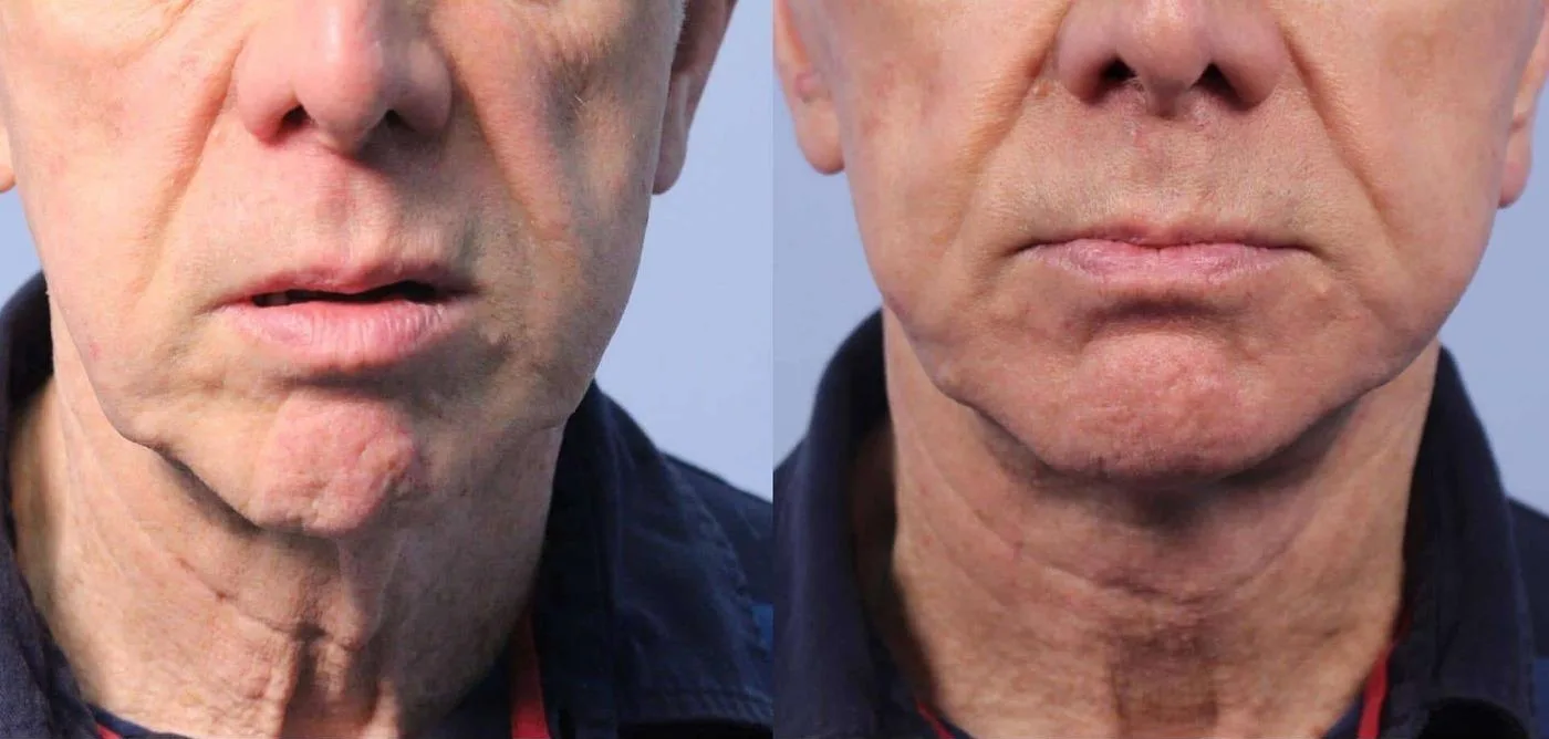 Neck Lift - Before and After Gallery - Patient Photo 38