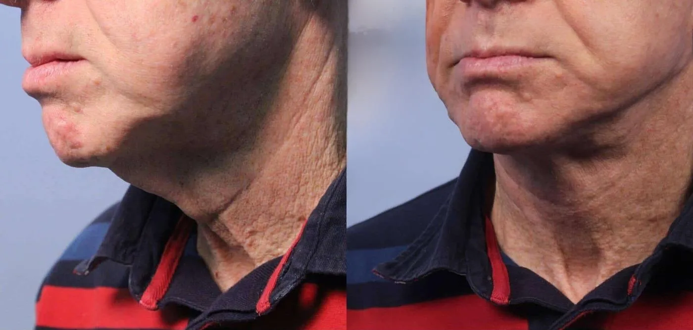Neck Lift - Before and After Gallery - Patient Photo 39