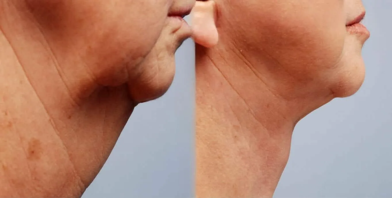 Neck Lift - Before and After Gallery - Patient Photo 4